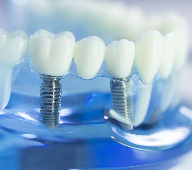 Suwanee Dental Implants