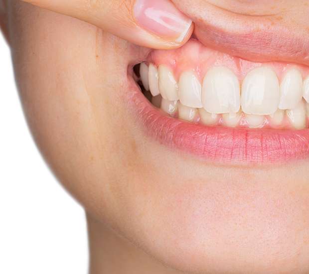 Suwanee Gum Disease