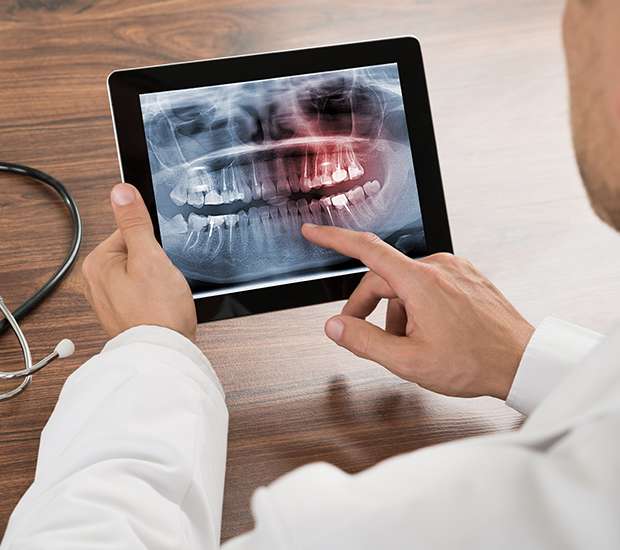 Suwanee Types of Dental Root Fractures