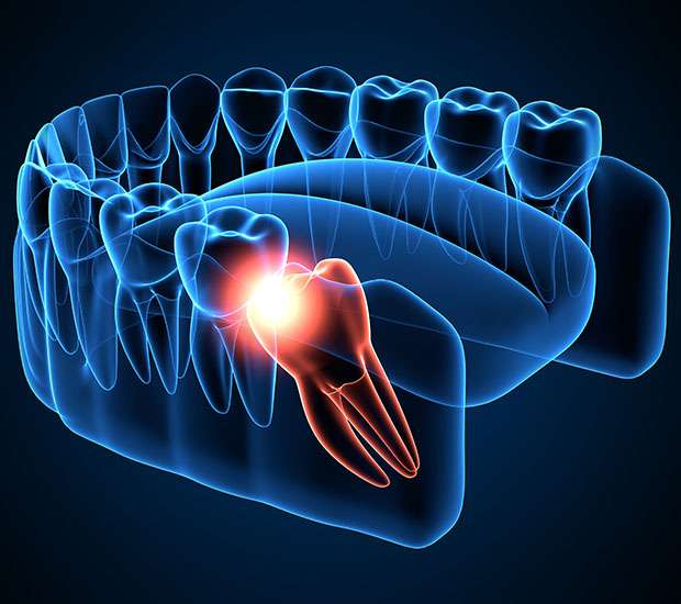 Suwanee Wisdom Teeth Extraction